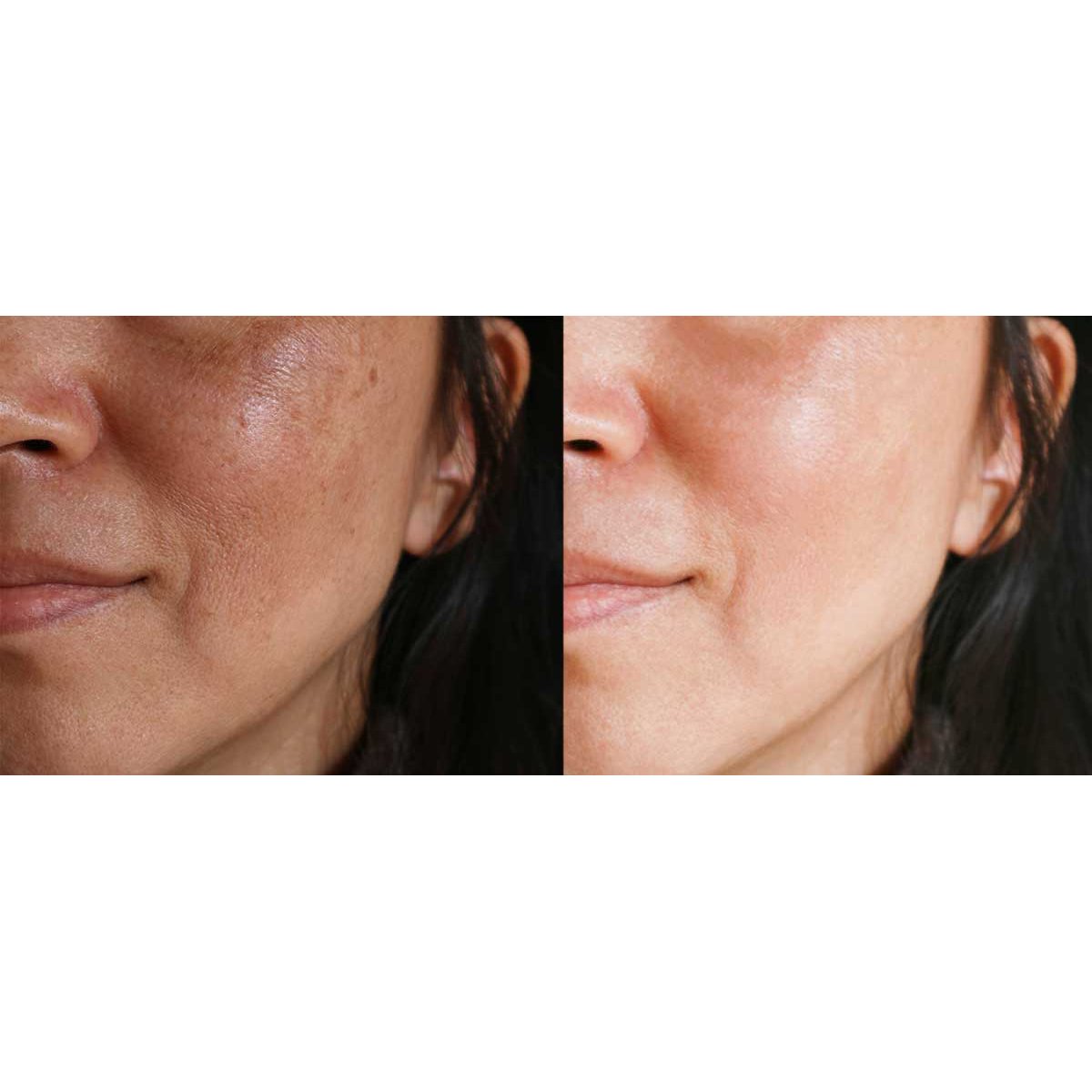 Before and after facial treatment concept. Face with melasma and