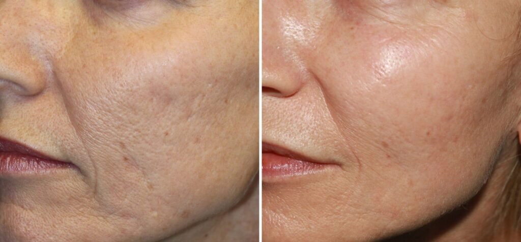 Microneedling Success Stories