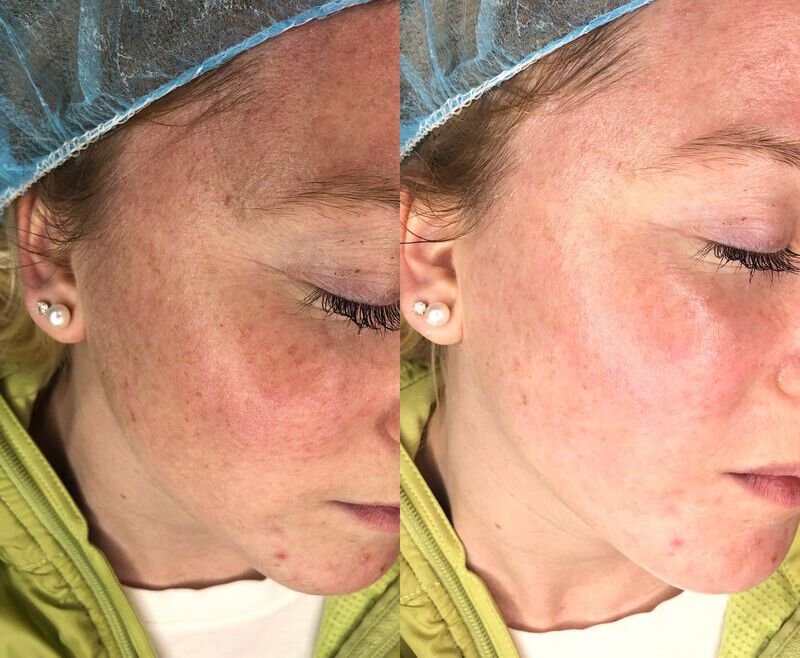 Our Clients_ Dermaplaning Results