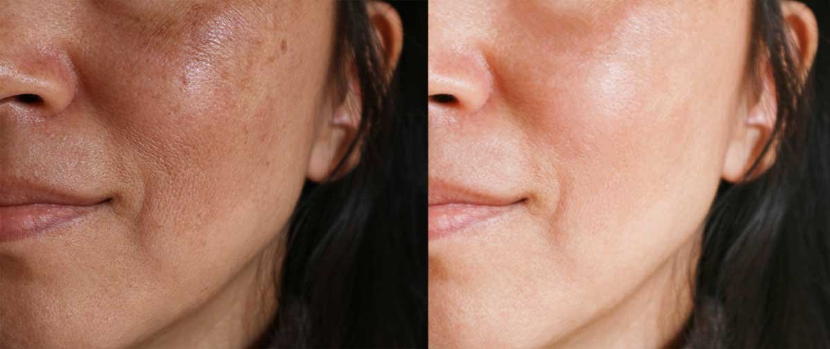 Real-World Melasma Reduction Results