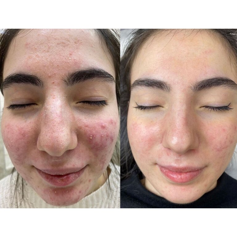 green-peel-before-after