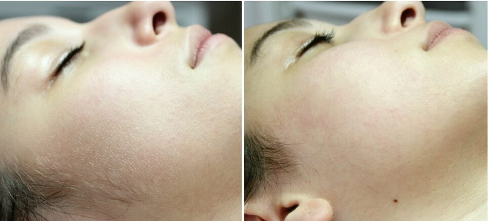 hair free skin after dermaplaning treatment